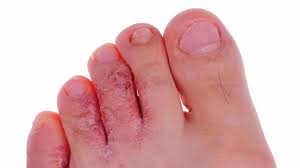 Athlete's foot skin peeling